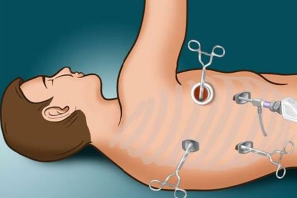 Thoracoscopy Test