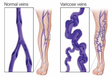Varicose Vein