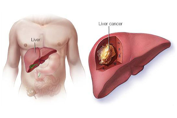 Liver Cancer