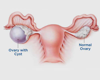 Ovarian Cyst