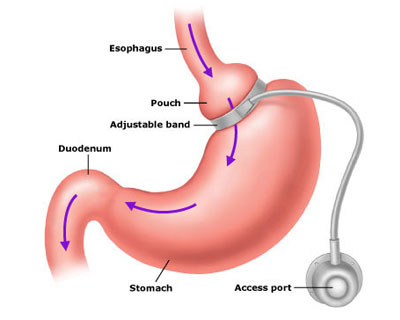 Weight Loss Surgeries in Kolhapur
