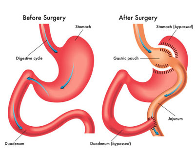 Weight Loss Surgeries in Kolhapur