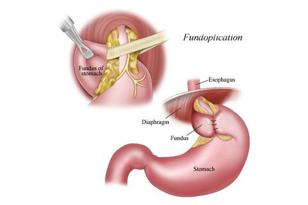 GERD Treatment in Maharashtra
