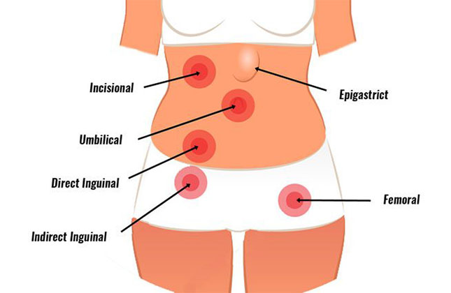 Hernia Types