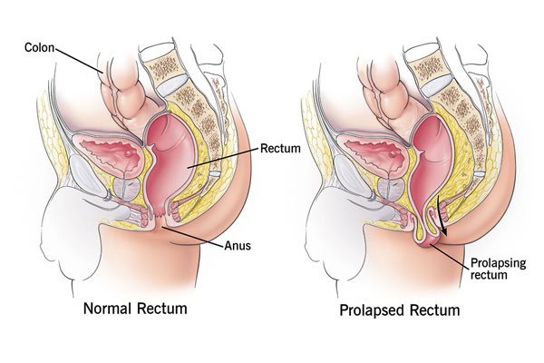 Rectal Prolapse