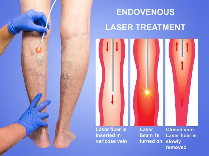 Laser Treatment for Vericose Vein